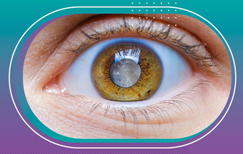 Лечение катаракты в Днепре ᐈ Цена лечения катаракты – cataracta.in.ua